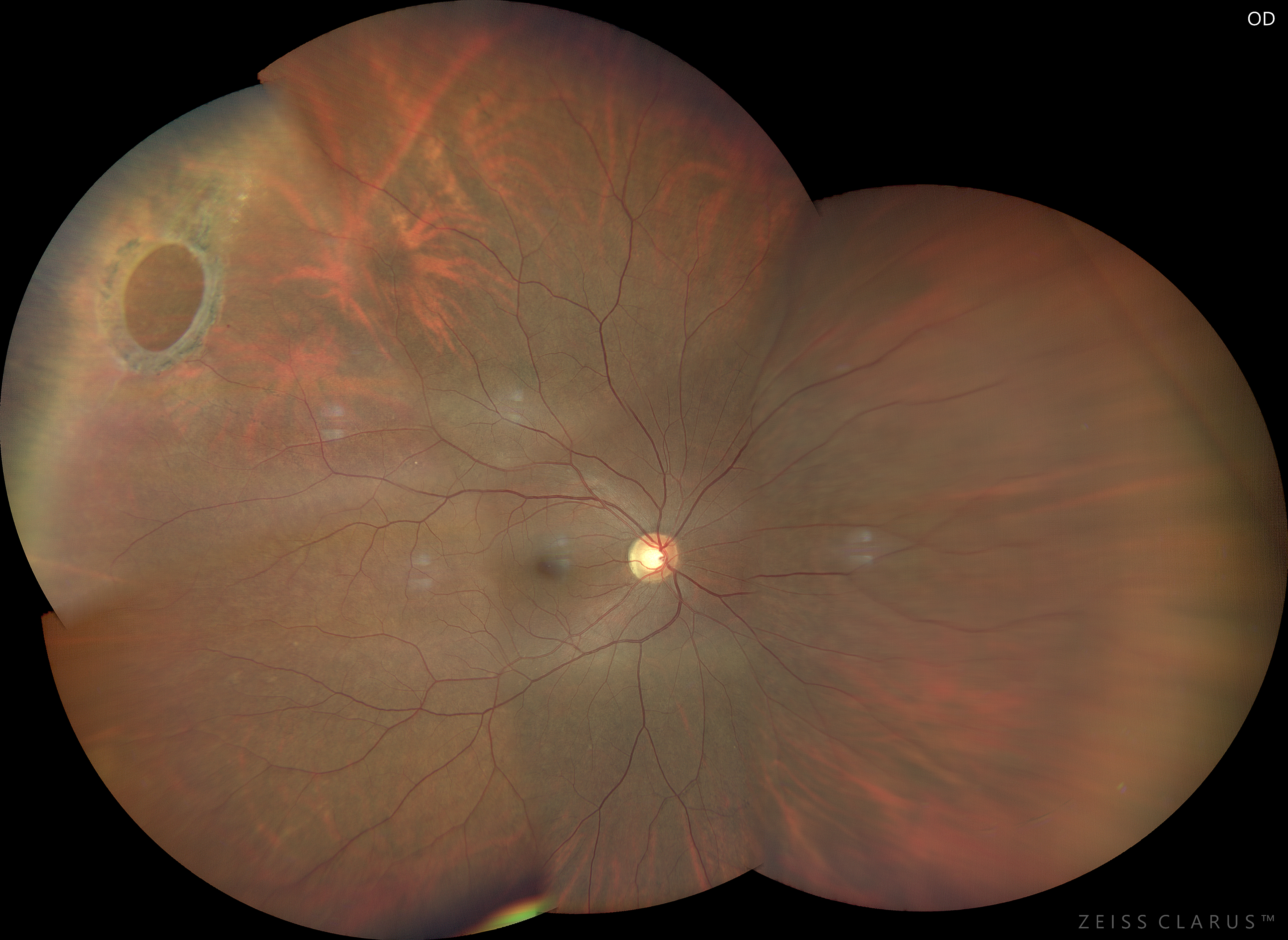 Misurazioni lineari e di area discrepanti su un foro retinico gigante con imaging ultra widefield